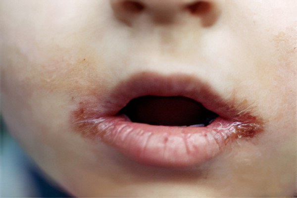 Рубцы вокруг губ