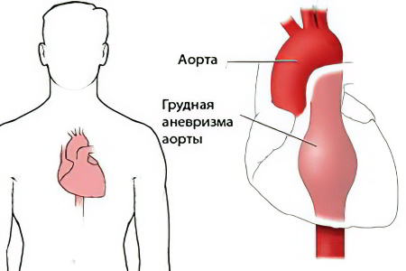 Аневризма аорты Аневризма аорты