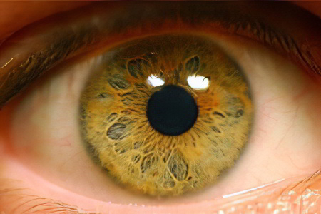Ангиопатия сетчатки глаза