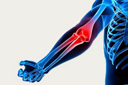 Артроз локтевого сустава – причины, симптомы, степени и лечение деформирующего артроза локтевого сустава