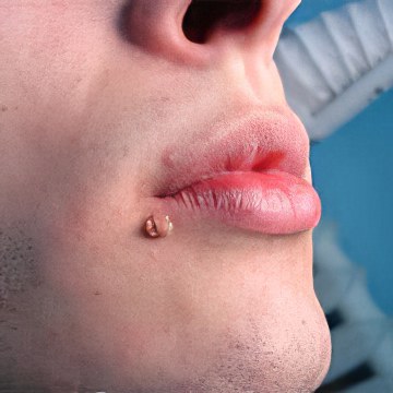 Можно ли при беременности использовать чистотел от бородавок