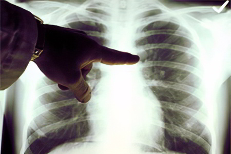 Рентгенография лёгкого