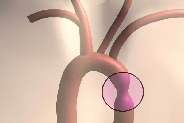 Коарктация аорты – причины, симптомы и осложнения коарктации аорты Коарктация аорты – причины, симптомы и осложнения коарктации аорты