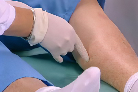 Диагностика тромба в ноге