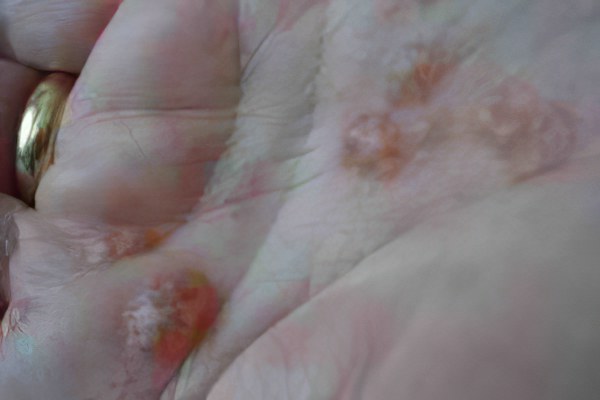 Дисгидротическая экзема на пальцах рук – причины и симптомы