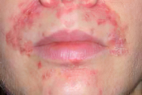 >> Экзема на лице