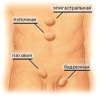 Виды грыж Виды грыж