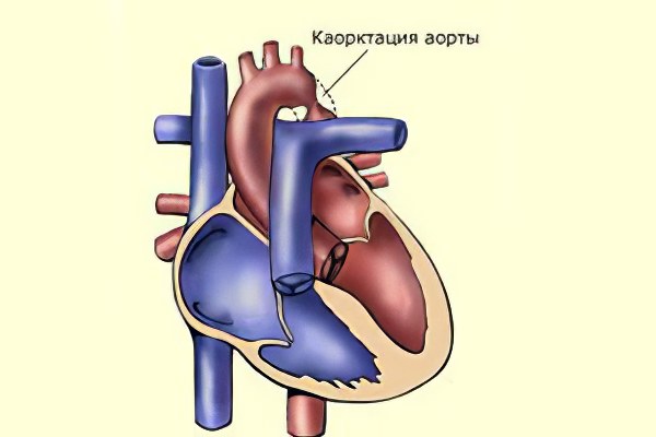 Коарктация аорты – причины, симптомы и осложнения коарктации аорты Коарктация аорты – причины, симптомы и осложнения коарктации аорты