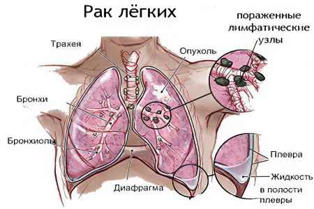 Классификация рака лёгких