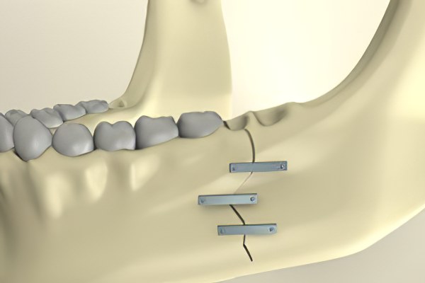 Лечение перелома челюсти