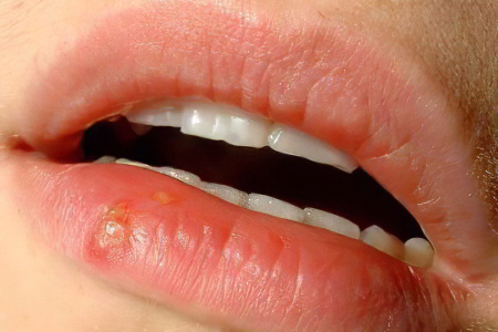 Начальная стадия рака губы