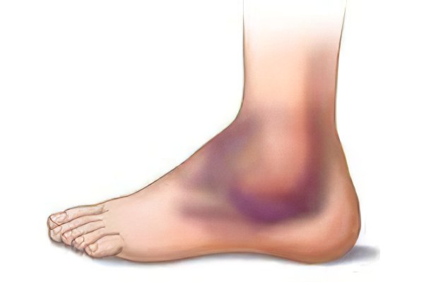 Отёк ноги после перелома – причины отеков, как снять?