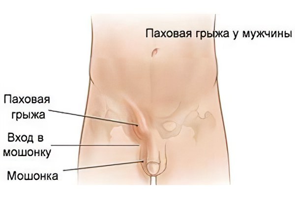 Паховая грыжа у мужчин Паховая грыжа у мужчин