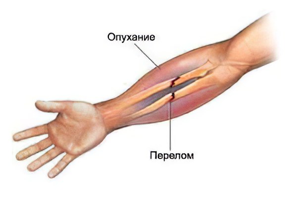 Перелом кости руки – симптомы, как разработать руку после перелома?