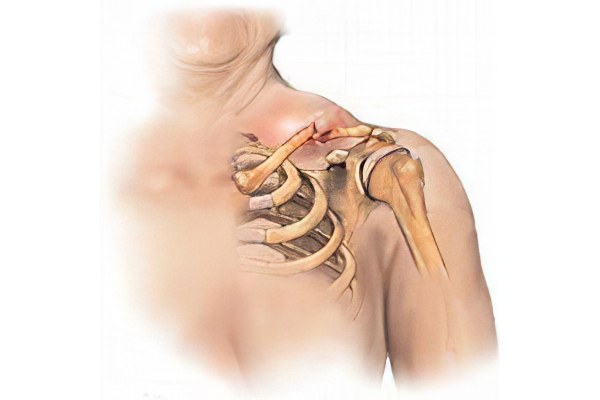 Перелом плечевой кости со смещением