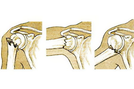 Перелом хирургической шейки плеча