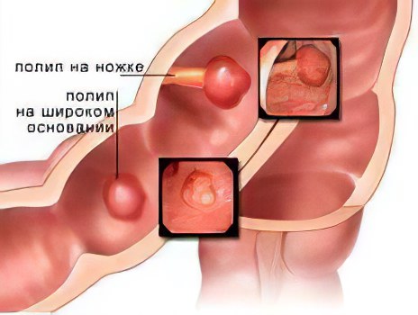 какую диету нужно соблюдать после инфаркта или диета вода перед едой