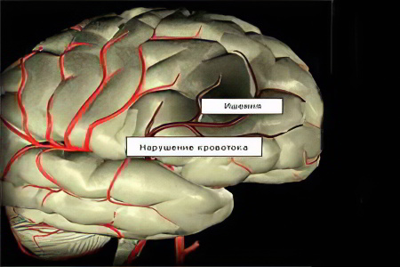 Причины ишемии головного мозга
