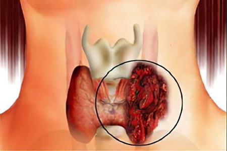 Рак щитовидной железы