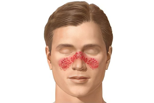 Симптомы стафилококка на лице