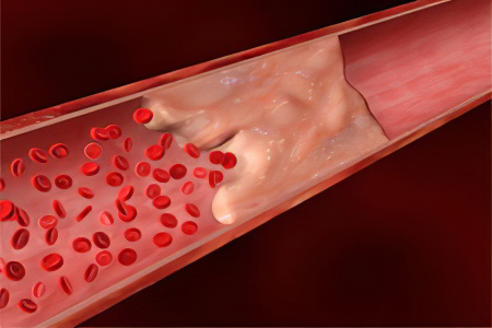 Тромбоз брыжеечной артерии