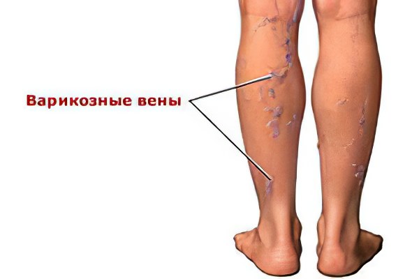 Варикоз на ногах Варикоз на ногах