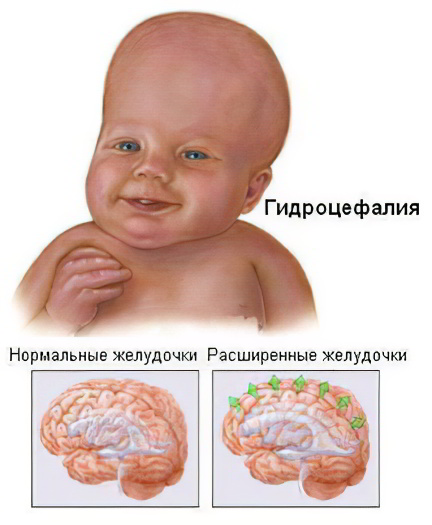 Как узнать что у тебя водянка Как узнать что у тебя водянка
