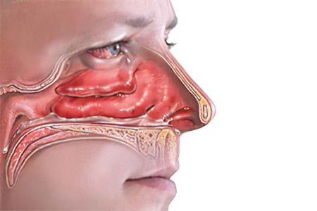 Причины и симптомы аденоидов в носу