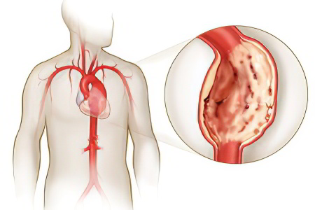 Аневризма аорты сердца