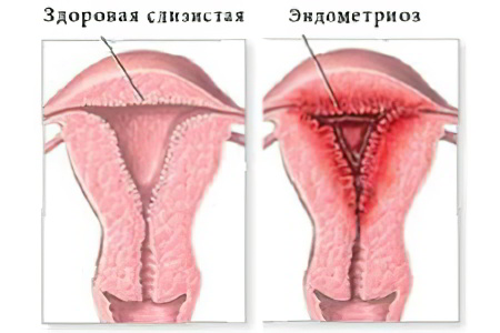 Эндометриоз матки у женщин – что это такое? Симптомы и лечение