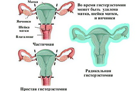 Виды операций по удалению матки