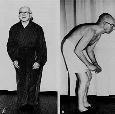 болезнь Паркинсона 