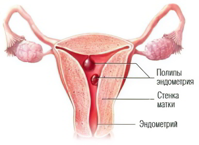 полип эндометрия полип эндометрия