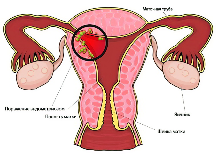 Эндометриоз матки у женщин – что это такое? Симптомы и лечение