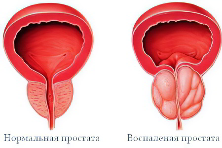 Простатит