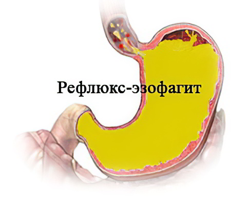 диета при энтероколите