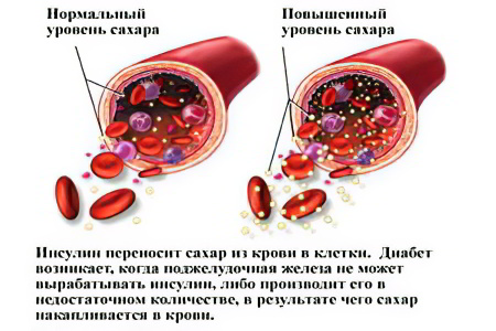 Сахар в крови