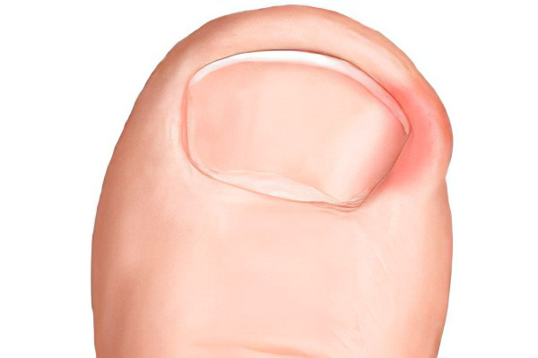 Симптомы вросшего ногтя