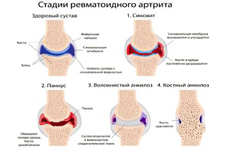 Как помочь при ревматоидном артрите Как помочь при ревматоидном артрите