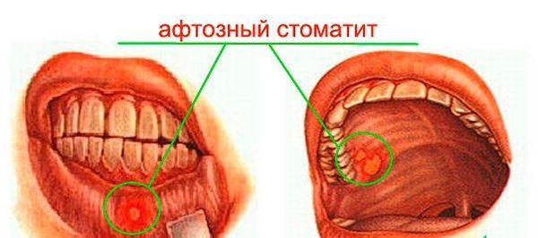 Афтозный стоматит