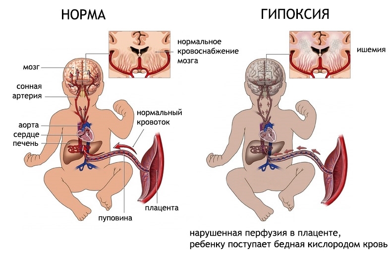 Гипоксически ишемическое поражение цнс синдром двигательных нарушений thumbnail