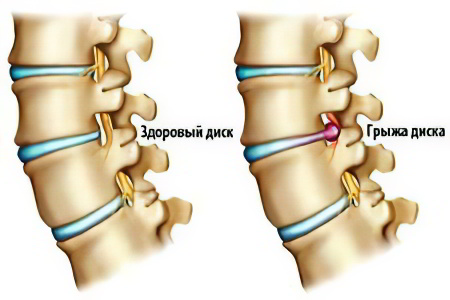 Как образуется шейная грыжа