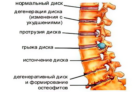 Строение межпозвоночных дисков