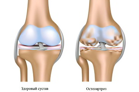 Остеоартроз коленного сустава