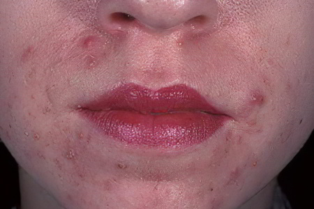 Аллергический дерматит на лице