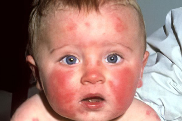 Аллергия на лице у новорожденных