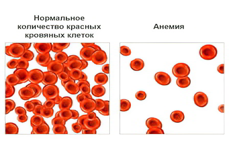 Анемия 1 степени