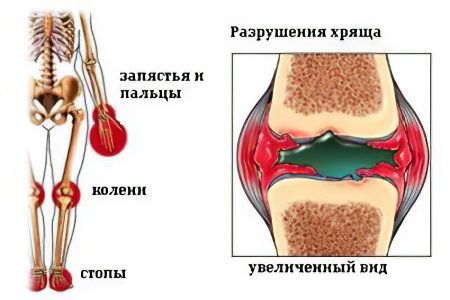 ювенильный артрит