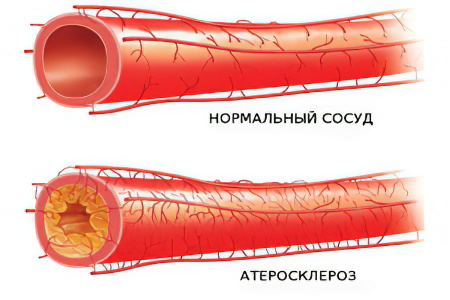 Атеросклероз