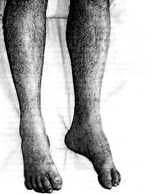 атрофии мышц ног